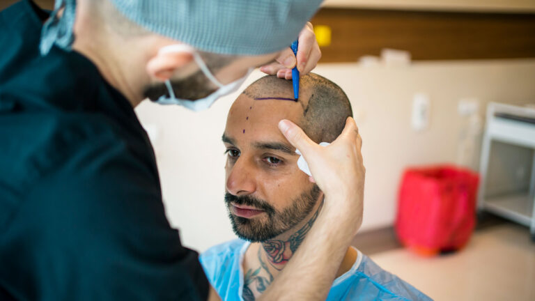 Restore Your Confidence with Hair Transplant Services at Wings Health